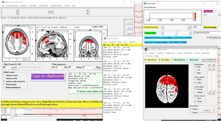 Figure 13 - Baseline eyes-open z-score LORETA analysis for 20 Hz